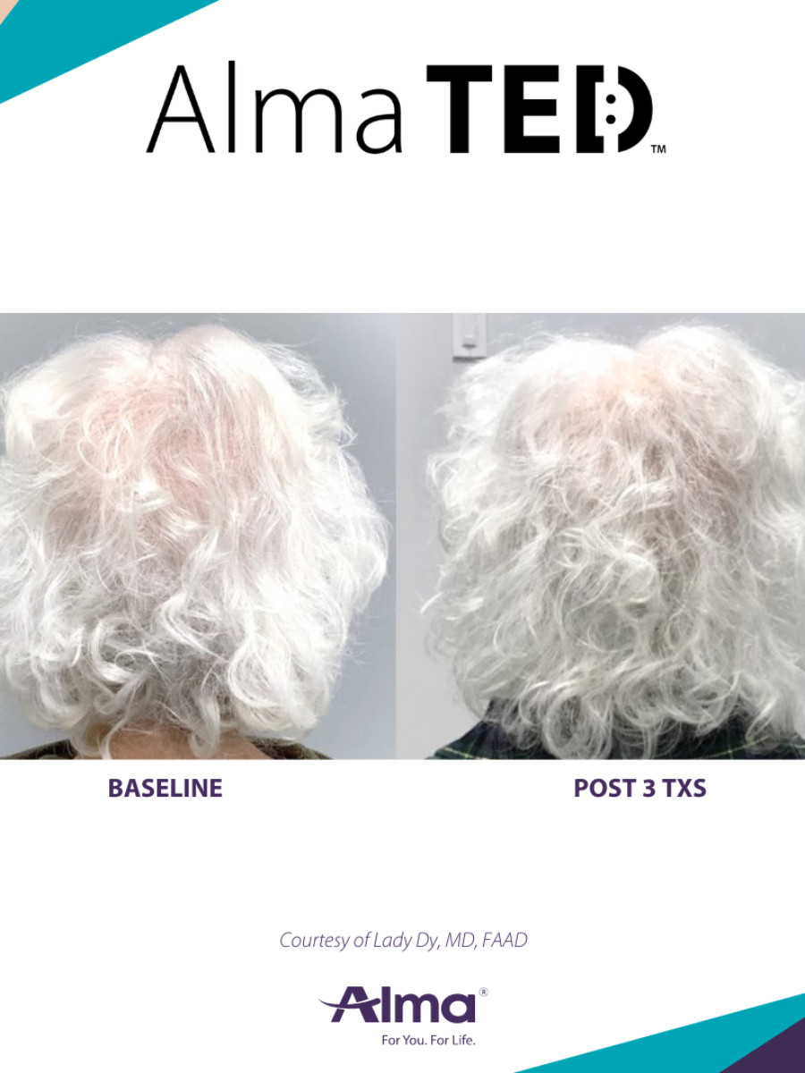 Before and After Results of Alma TED™ Hair Restoration