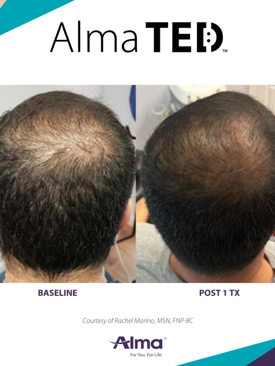 Before and After Results of Alma TED™ Hair Restoration