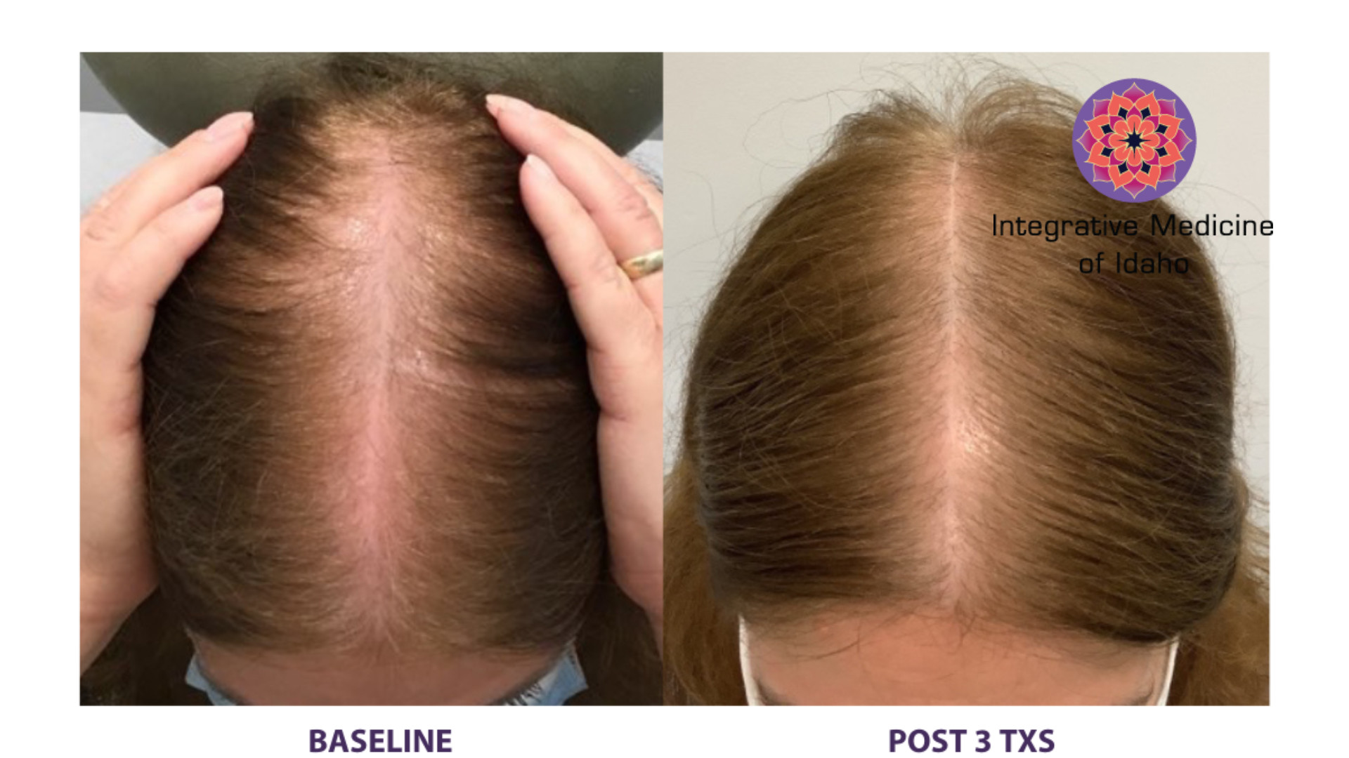 Alma TED Hair Restoration: Before and After 